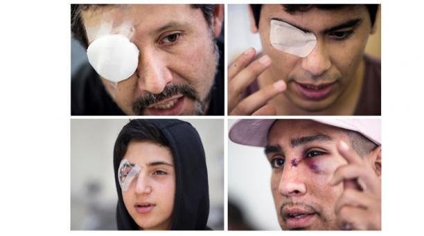 IACHR alarmed by the rising number of eye injuries caused in protests across South America